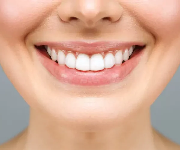 Diş Taşı Temizliği 1 after1