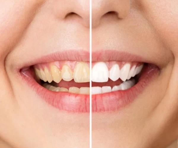 Diş Beyazlatma 1 img1 5