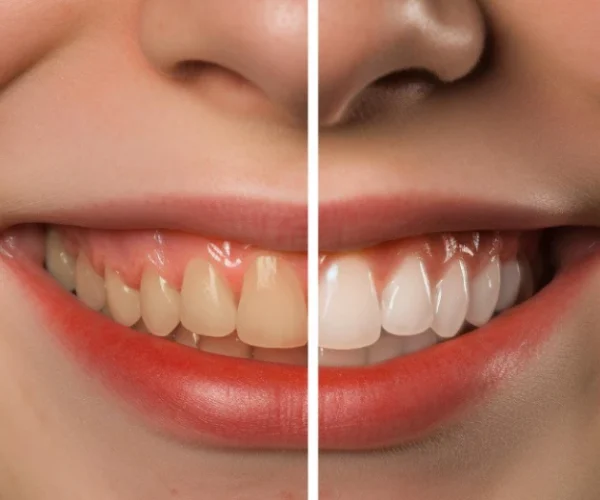 Lamine Veneer (Porselen Lamina) 1 img4 3